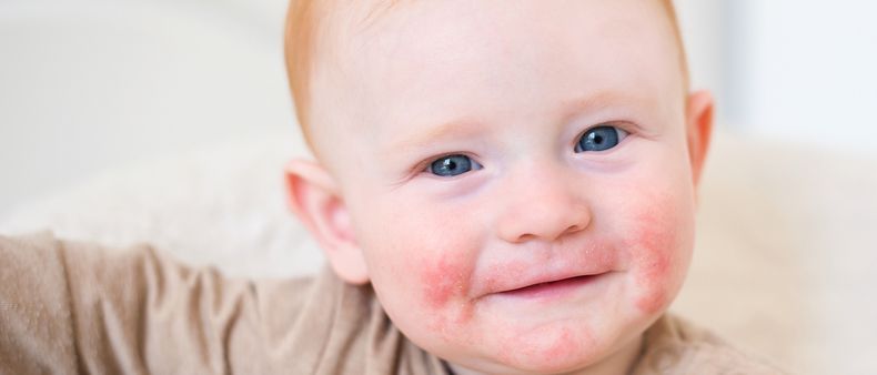 Atopowe zapalenie skóry (AZS) u dzieci - czy można wesprzeć leczenie naturalnymi sposobami?
